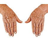   Hands, Skin, Age Spots